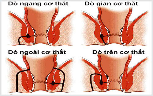 4 loại rò hậu môn