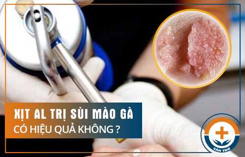 Xịt AL Trị Sùi Mào Gà Có Hiệu Quả Không?