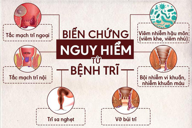 Biến Chứng Nguy Hiểm Của Bệnh Trĩ Và Cách Điều Trị Hiệu Quả Nhất