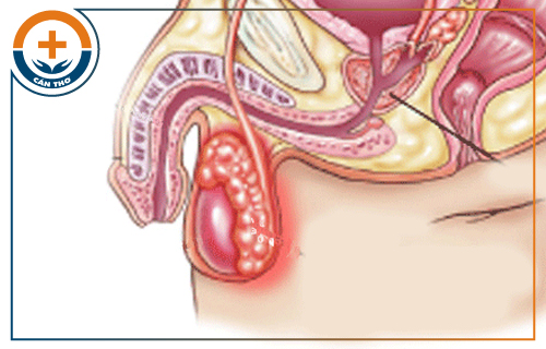 Tinh hoàn bị phù ở nam giới: nguyên nhân và cách chữa