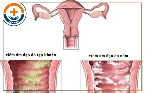 Biểu hiện của bệnh viêm âm đạo phụ nữ