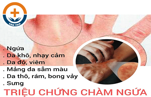 Chàm Ngứa Là Bệnh Gì? Nguyên Nhân Và Cách Trị Hiệu Quả