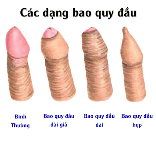 Cách làm ngắn bao quy đầu an toàn