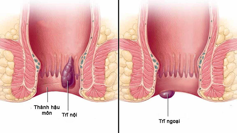 Đại tiện ra máu do đâu và hỗ trợ điều trị như thế nào?