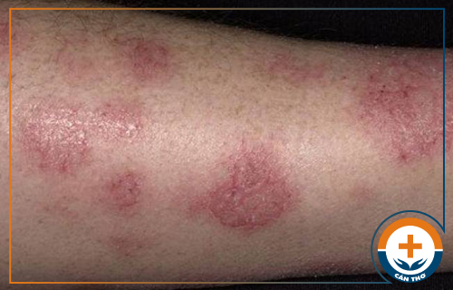 Bệnh eczema là gì? Cách điều trị hiệu quả