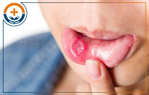 Dấu hiệu của bệnh giang mai ở miệng