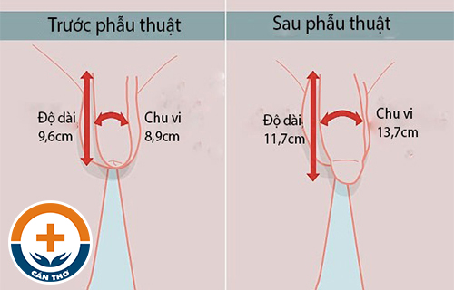 Phẫu thuật kéo dài dương vật như thế nào?