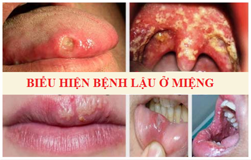 Bệnh lậu là bệnh gì? Tổng hợp hình ảnh của bệnh lậu ở các bộ phận trên cơ thể