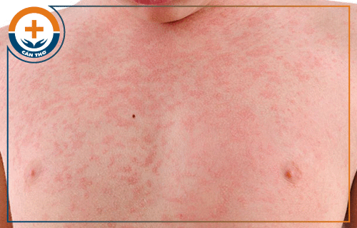 Nổi mẩn đỏ, chấm đỏ và ngứa da là bệnh gì? Nguyên nhân và cách trị hiệu quả