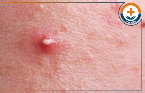 Nguyên nhân gây ra mụn nhọt trên da là gì?