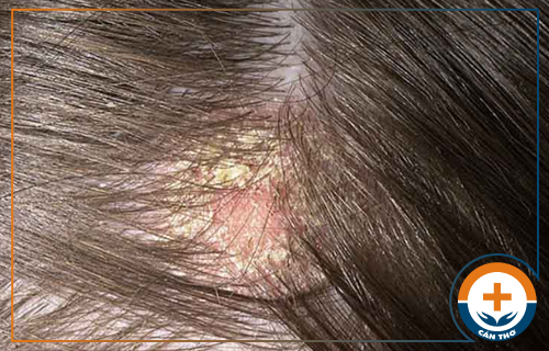 Cách trị nấm da đầu hiệu quả bằng phương pháp hiện đại