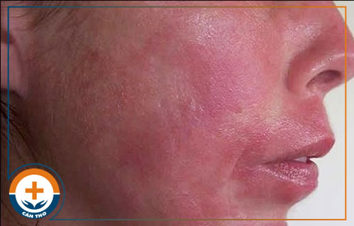 Ngứa da mặt là dấu hiệu của bệnh gì?