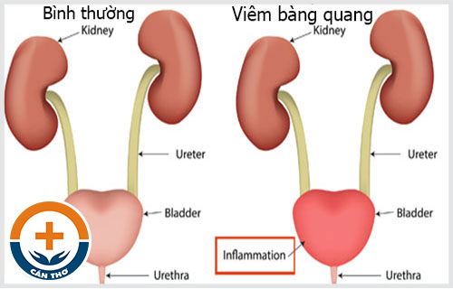 Nguyên Nhân Bị Viêm Bàng Quang - Biết Để Điều Trị Sớm