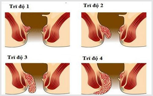 Dấu hiệu trĩ nội