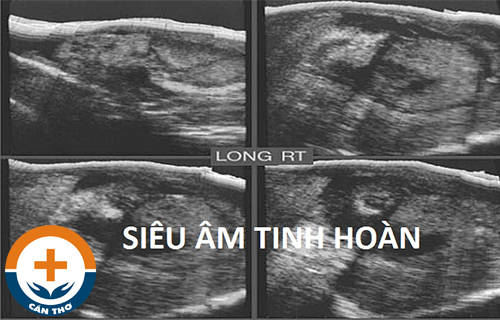 Siêu âm tinh hoàn là gì? Vì sao cần siêu âm tinh hoàn?