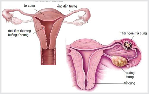 Biến chứng bệnh viêm vùng chậu