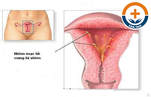 Viêm Nội Mạc Tử Cung Là Gì? Cách Điều Trị Hiệu Quả